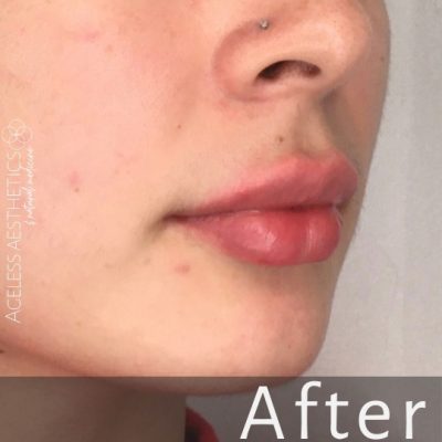 Side view of a person's lower face showing smooth, fuller lips and clear skin. The word "After" is displayed at the bottom, indicating the result of a natural lip filler treatment.