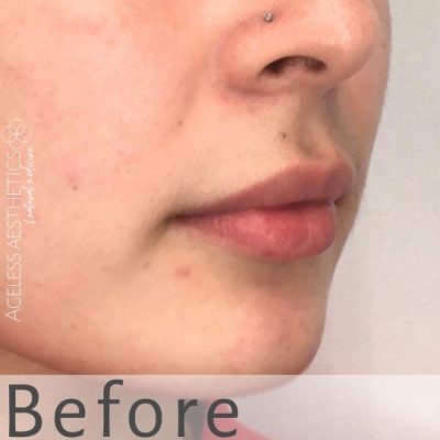 Close-up of the lower half of a person’s face, showing natural lips; the word "Before" is overlaid at the bottom. A small nose stud is visible, highlighting lips before any natural lip filler treatment.
