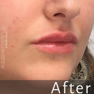 Close-up of the lower face of a person with a nose ring and large earring, showing smooth, plump lips. The word "After" is overlaid at the bottom, suggesting a cosmetic treatment result.