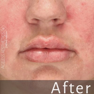 Close-up of a person's lips and lower face with smooth, plump lips and clear skin. The word "After" is displayed at the bottom, suggesting this is a post-treatment image. The left side has "Ageless Aesthetics" branding.