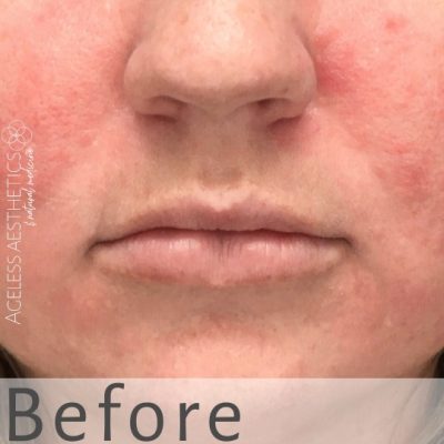 Close-up of the lower half of a person's face with redness and irritation on both cheeks. The word "Before" is overlaid at the bottom, and "AGELESS AESTHETICS" is written along the left side, hinting at upcoming natural lip filler results.