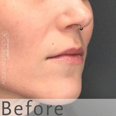 Close-up of the lower half of a young woman's face with a nose ring, showing naturally thin lips and skin texture. The word "Before" is overlaid at the bottom, indicating this pre-treatment image may be used to show balanced face results after lip filler.
