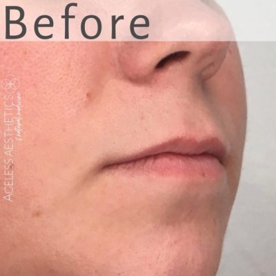 Close-up of the lower half of a young woman's face showing untreated skin and lips, with the word "Before" overlaid at the top. The natural lips appear prior to any lip filler treatment.