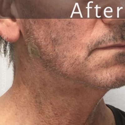 A close-up of a man's lower face and neck, showing a tightened and defined jawline and neck after lifting threads. The word "After" is overlaid at the top. Subtle stubble is visible on his chin and jaw.