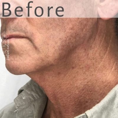 Close-up of the lower face and neck of an older man with visible facial lines, and sagging skin, highlighting the need for jawline tightening. The word "Before" is written at the top of the image.
