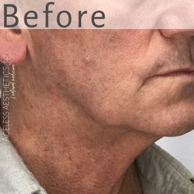 A close-up of the lower face and neck of an older man with wrinkles, and sagging jawline. The word "Before" is overlaid at the top, indicating a pre-treatment condition.