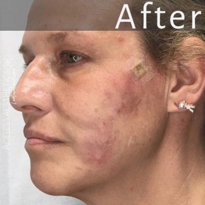 A close-up angled view of a woman’s face after a lifting thread procedure, with redness and a small bandage near her cheekbone. Demonstrating a lifted cheek and smoothed out smile lines. The word "After" is visible at the top.