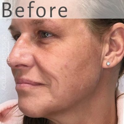 A close-up, angled view of a middle-aged woman’s face showing signs of aging and smile lines, with the word “Before” displayed at the top.