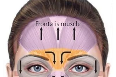 Illustration of a human face showing the frontalis muscle on the forehead highlighted in purple, with black arrows indicating the direction of muscle movement upward.