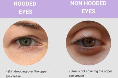 A comparison of two eyes: the left shows a hooded eye with skin drooping over the upper crease, while the right shows a non-hooded eye with the crease fully visible. Text labels and descriptions highlight the differences.