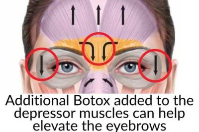 Diagram of a face highlighting eyebrow and forehead muscles with arrows and circles, illustrating how Botox in depressor muscles can help elevate the eyebrows; text explains this concept.