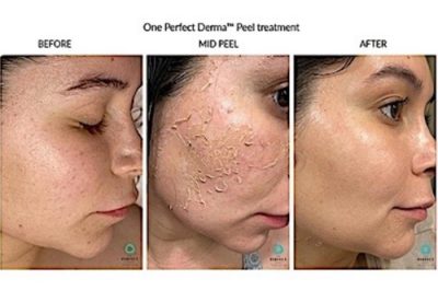 Three side-by-side photos of a woman's face: before, mid-peel (skin visibly peeling), and after a Perfect Derma Peel treatment, showing smoother, clearer skin in the final image.